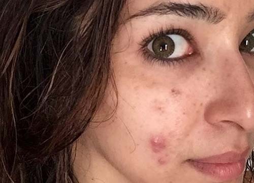 Anestop acne scars therapy