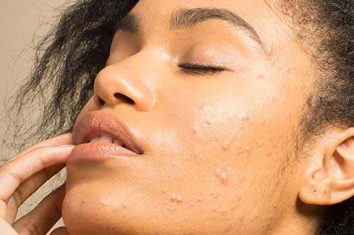 Acne scars solutions