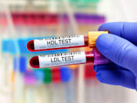בדיקות כולסטרול / צילום: Shutterstock