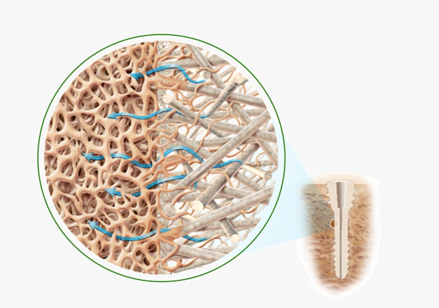 פעולת השתל בגוף / אילוסטרציה: באדיבות אוסיו