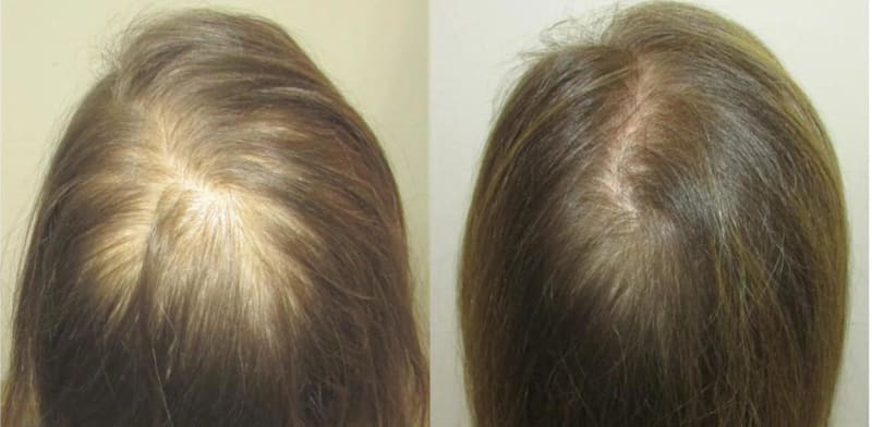 לפני ואחרי טיפולים במערכת MCT / צילום: ד''ר אלון שניידר