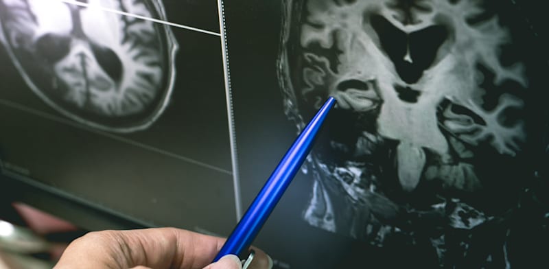 "המחקר העלה אפשרות לקשר בין פרקינסון לווירוס HPgV / צילום: Shutterstock, Atthapon Raksthaput"