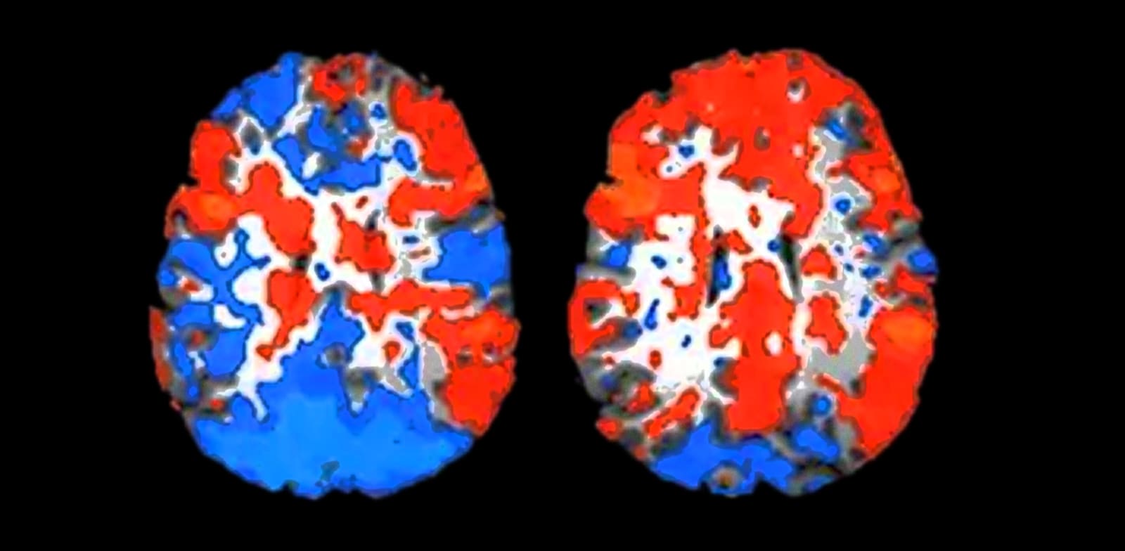 סריקת MRI של המוח במהלך שמיעת שיר מוכר. משמאל: סריקת מוח במהלך שמיעת שיר לא מוכר