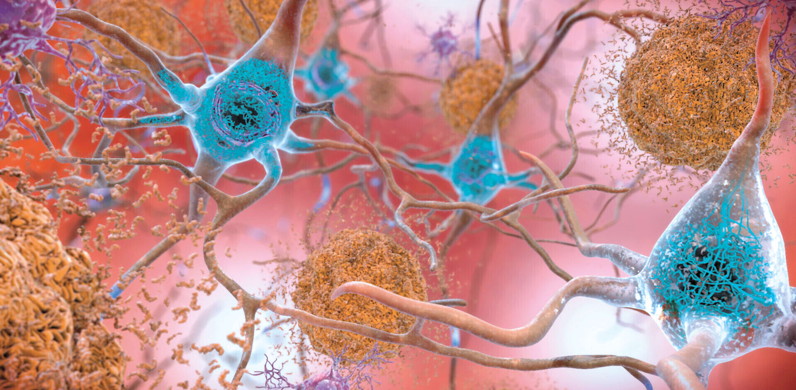 הדמייה של נוירונים במוח של חולה באלצהיימר. רמות חריגות של בטא עמילואידים שמתקבצים יחד ליצירת פלאקים / צילום: Associated Press, national institute on aging - NIH