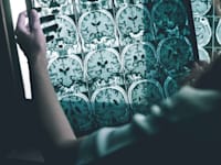 MRI של חולה עם אלצהיימר / צילום: Shutterstock, Atthapon Raksthaput
