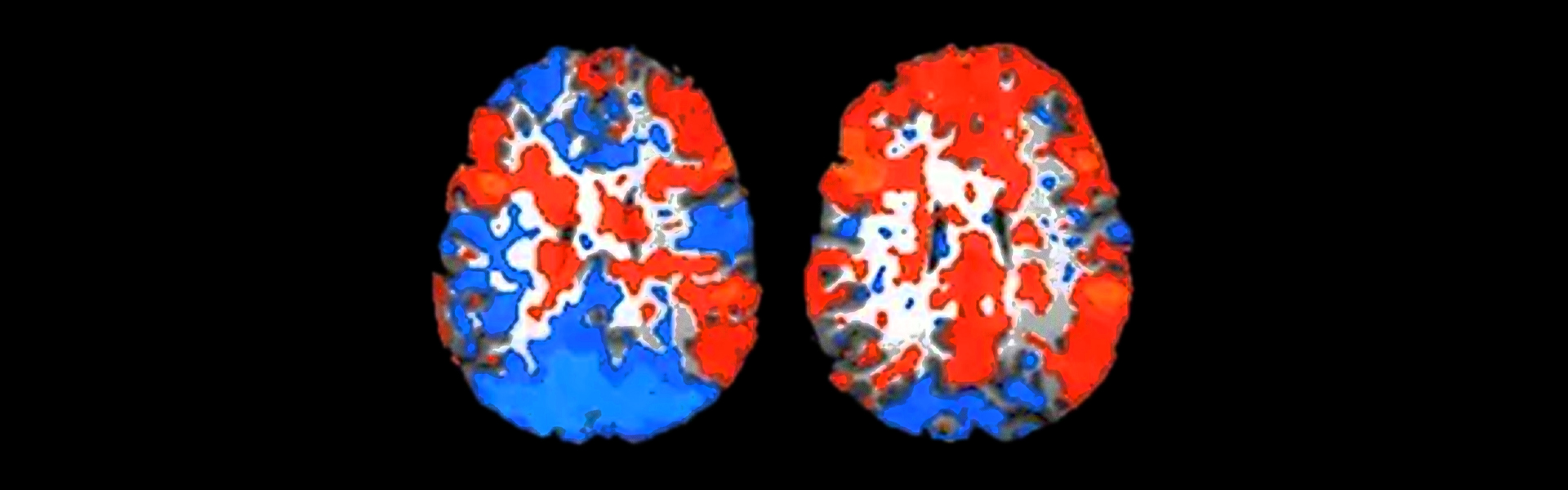 סריקת MRI של המוח במהלך שמיעת שיר מוכר. משמאל: סריקת מוח במהלך שמיעת שיר לא מוכר