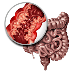 Inflammatory Bowel Disease - Treatment and Management