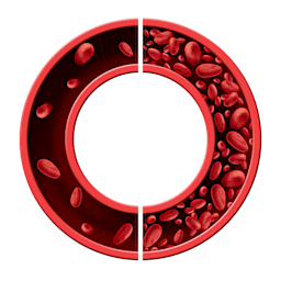 Iron Deficiency Anaemia in Adults - Diagnosis, Management and Prevention