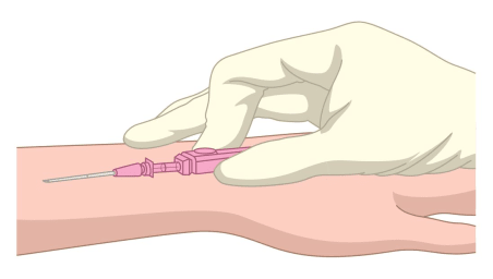 IV Cannulation (5/5) - A step-by-step procedural guide