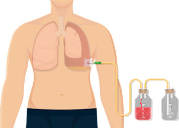 Chest Tubes and Underwater Seal Drains - Nursing Management