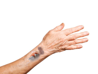 Skin tears in older people: Nursing care