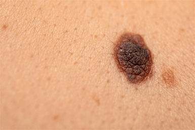 Melanoma