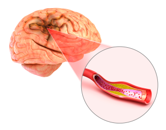 Pre-hospital Stroke Management