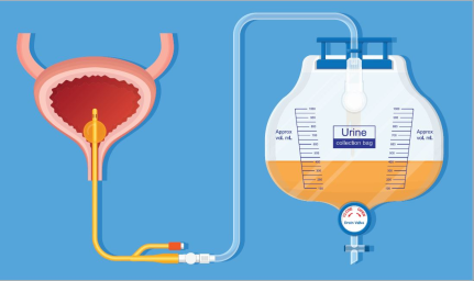 Indwelling Catheters - Insertion and management of short-term catheters