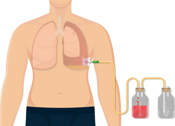 Chest Tubes and Underwater Seal Drains - Nursing Management