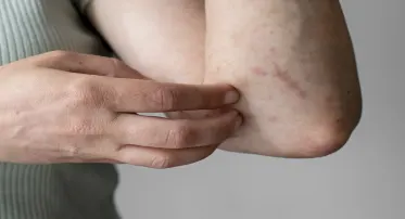 باقة الحساسيّة