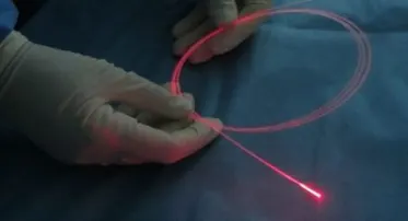 Bilateral Laser Catheterization + External Injection Session