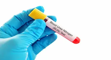 Blood Urea Nitrogen (BUN) test