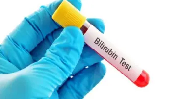 Bilirubin (Total) test