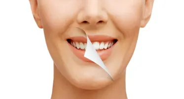 تبييض الأسنان بالليزر (لشخص واحد)