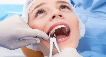 خلع بواقي جذور لسن أمامي