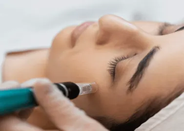 Mesotherapy session for dark circles