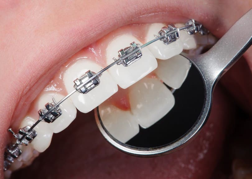 Orthodontic Braces