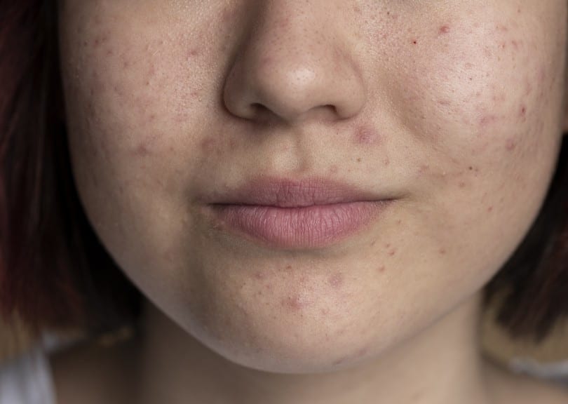 Roaccutane panel