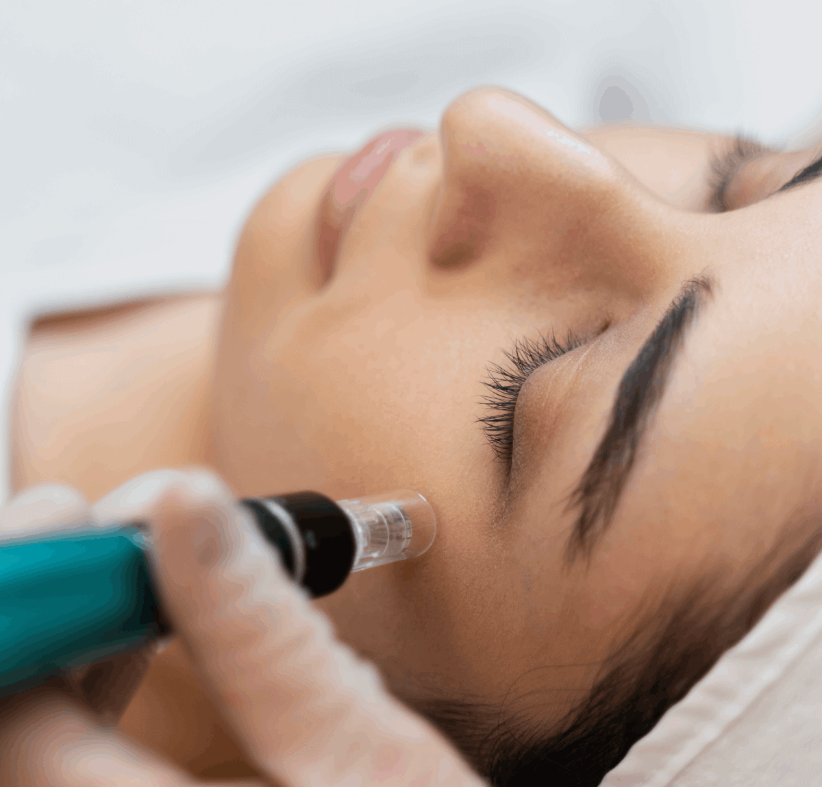 Mesotherapy session for dark circles