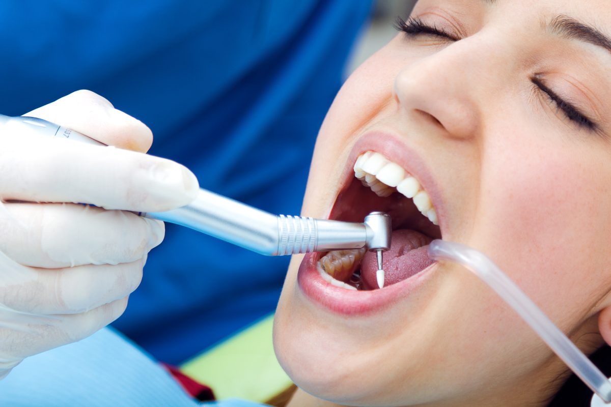 Dental fillings starting from