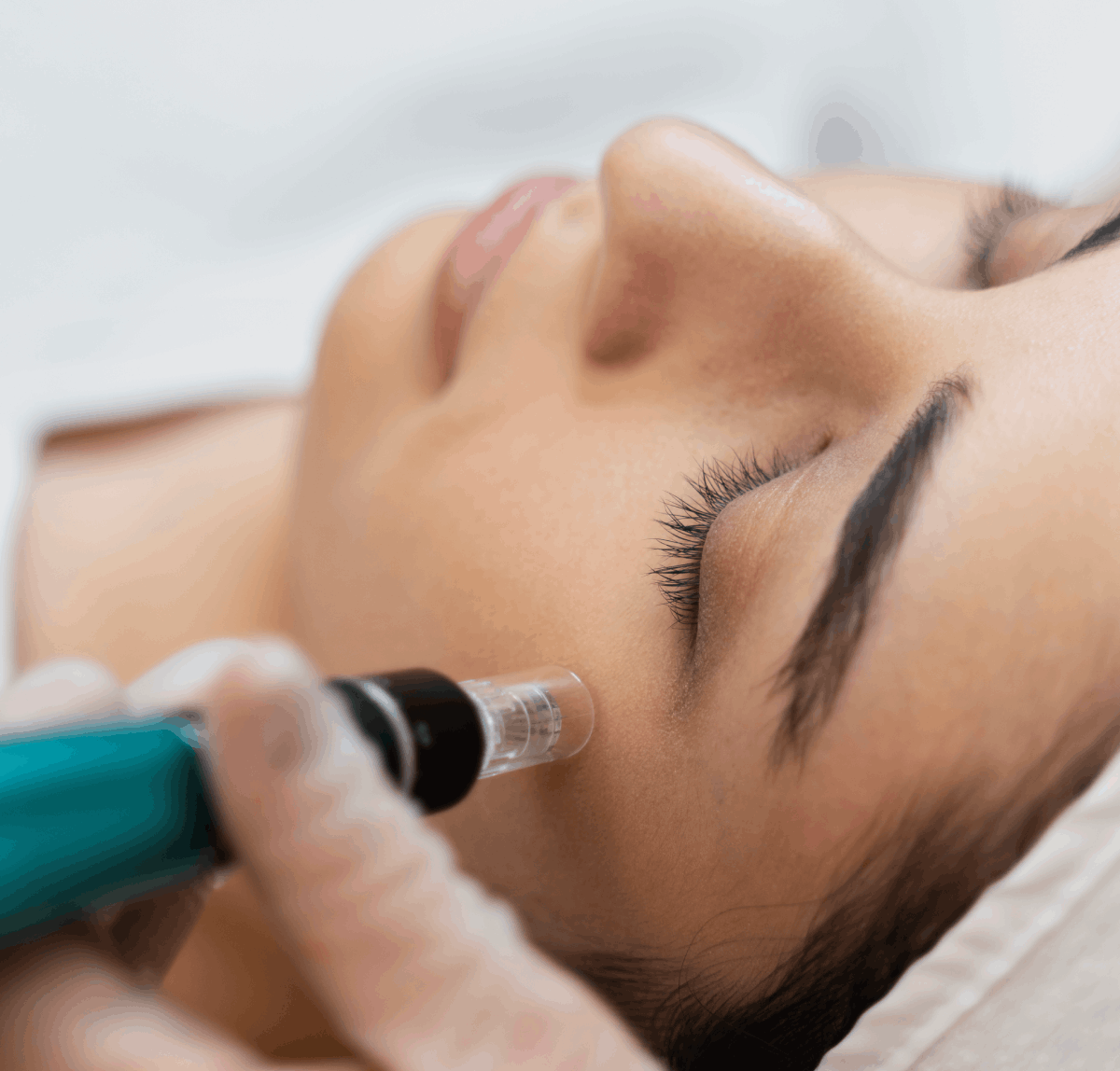 Fractional laser + mesotherapy