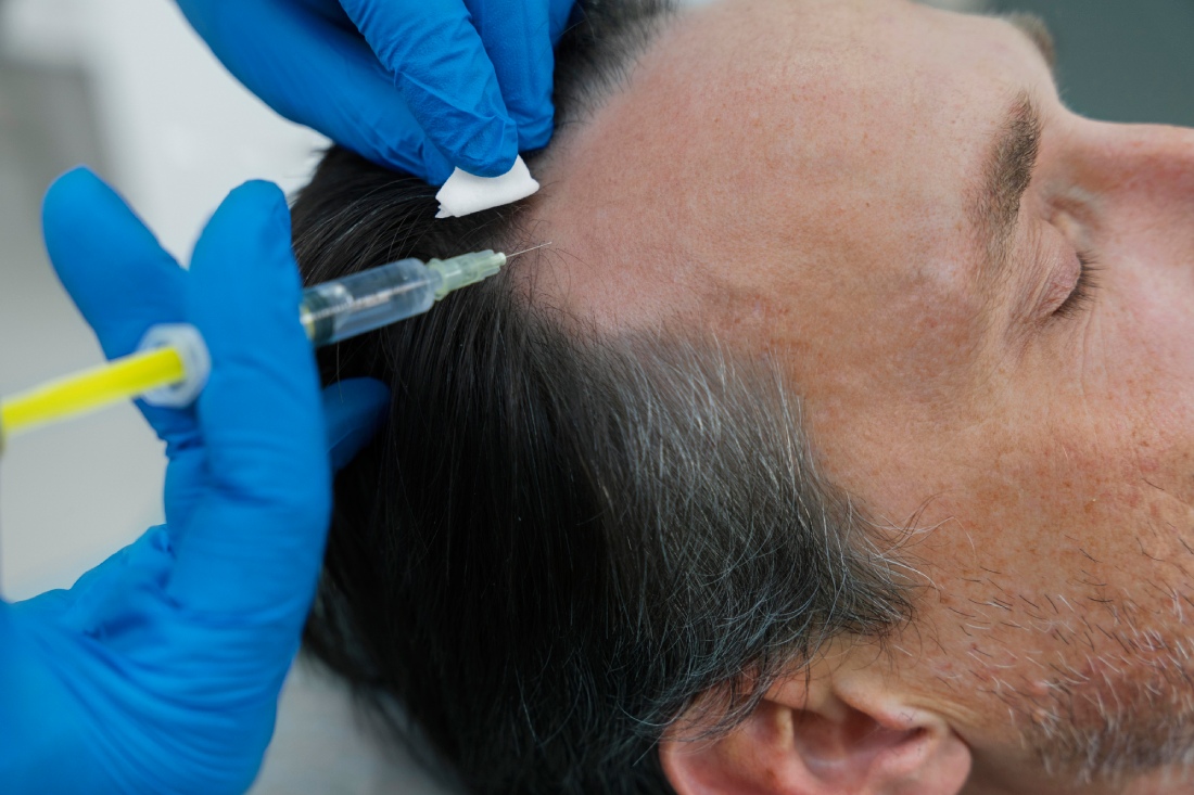 MESOTHERAPY FOR HAIR