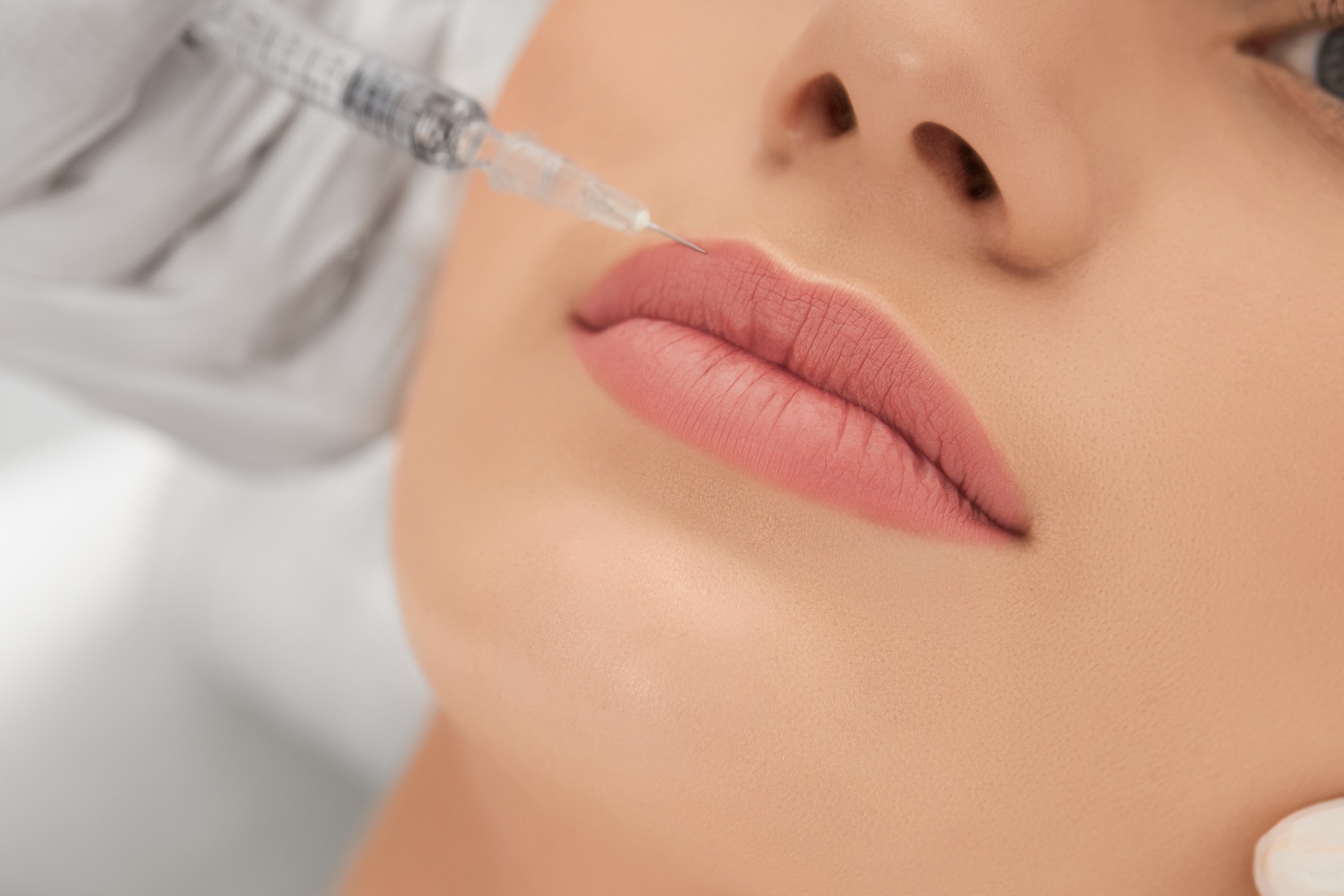 FILLER LIPS WITH BOTOX UPPER PART AND CARBON OR BLEACHING