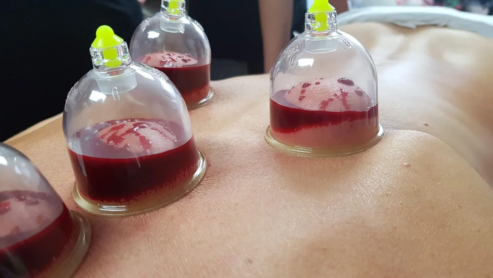 Therapeutic cupping