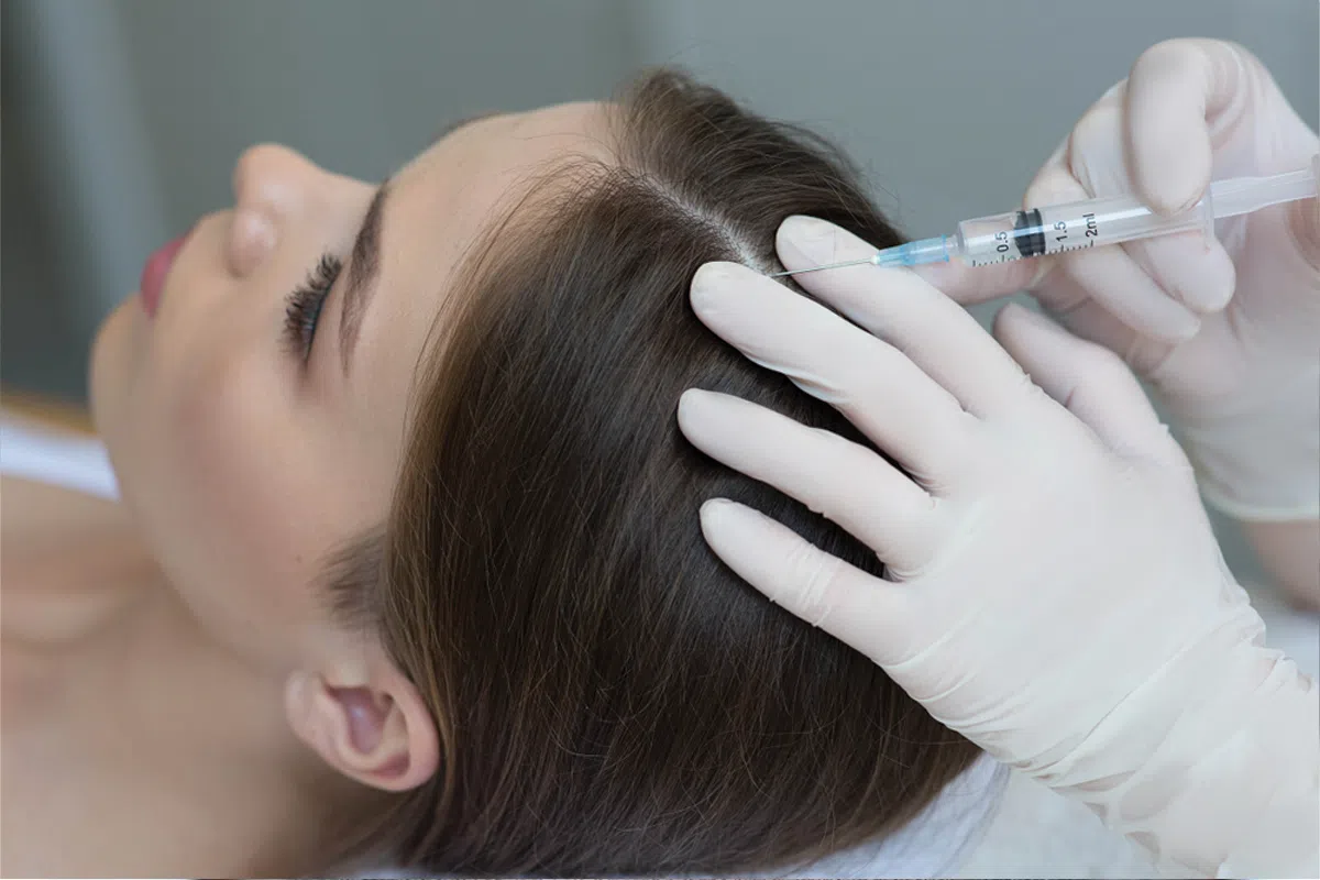 إبرة اكسوزوم لعلاج تساقط الشعر