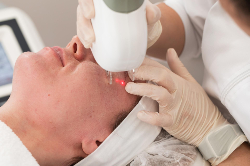 Full Face Transformer Session + 3 Jawline Filler Injections