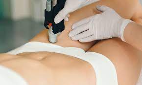 Bikini Area Filler Package 10 ml (with Free Laser Lightening Gift)