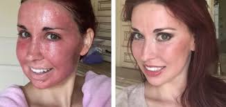 Fractional Facial Package with Skin Cleansing and Brightening