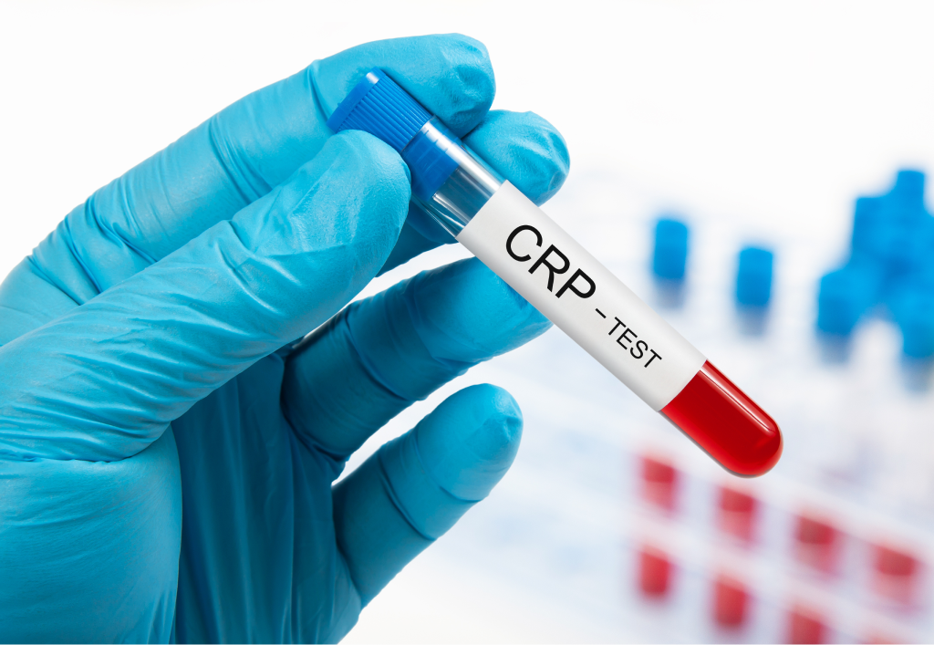 تحليل البروتين المتفاعل عالي الحساسية