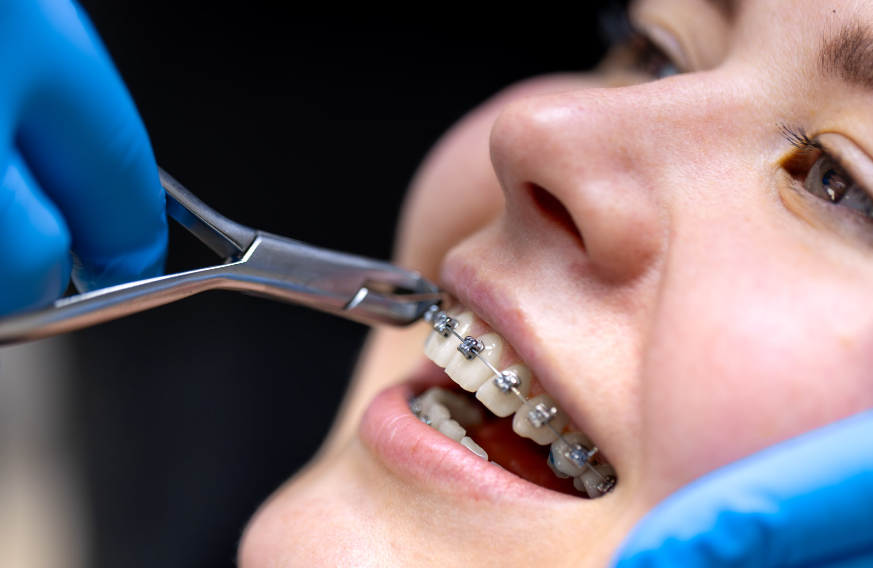 فك تقويم الأسنان