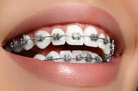 تقويم الاسنان المعدني دفعه اولى والباقى اقساط شهريه