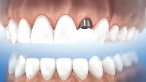 الزرعة الألمانية Trias - ixx2