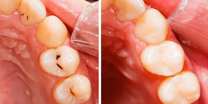 حشوة اسنان تجميلية