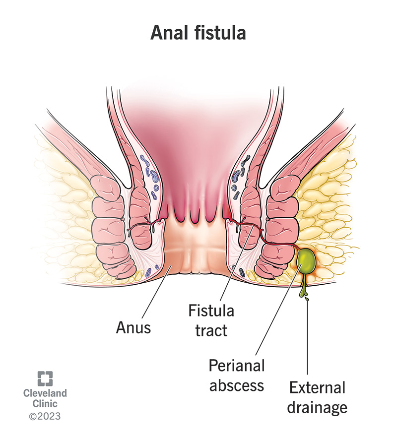 Fistula