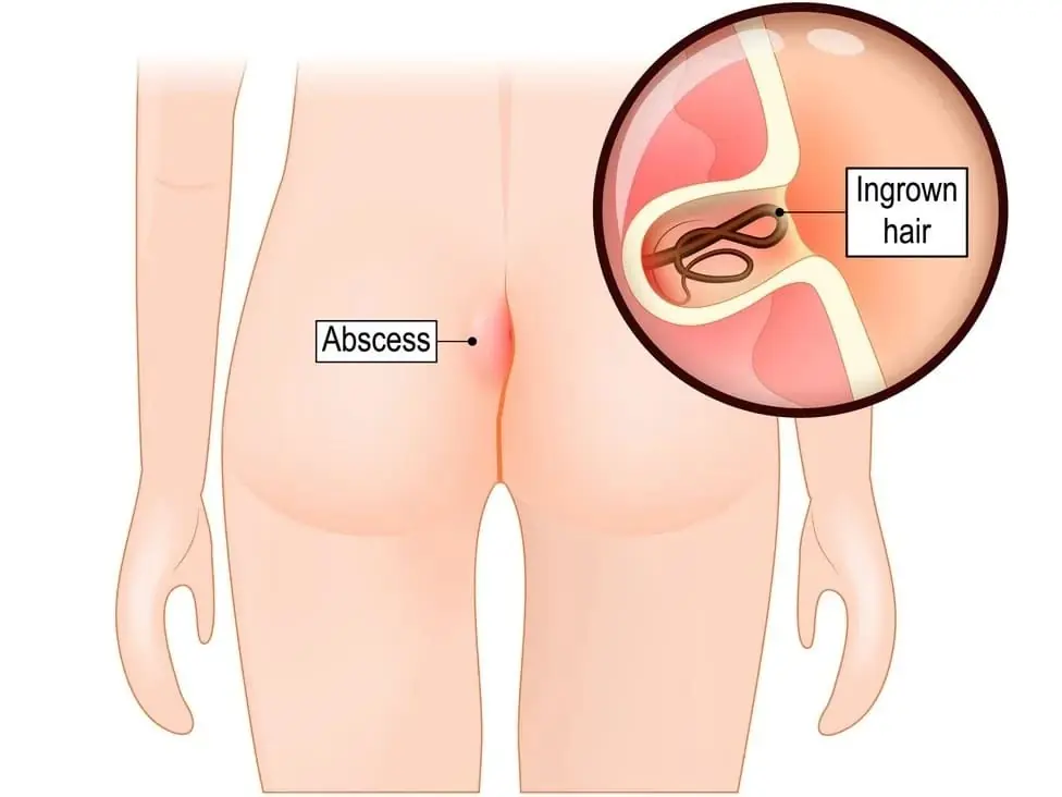 Pilonidal Sinus