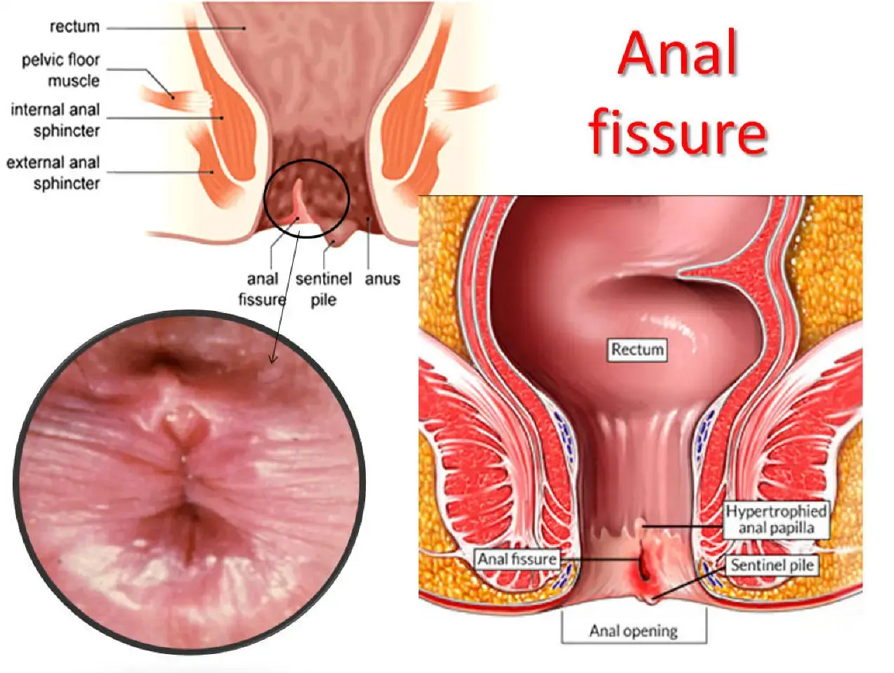 Fissure
