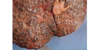 Stop Fatty Liver Disease