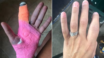 Houston Astros Fan's Gnarly Finger Injury Photos In T-Shirt Cannon