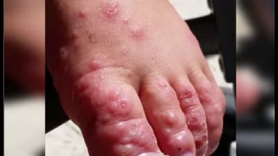 Hand foot and mouth disease very contagious affects kids 5 and