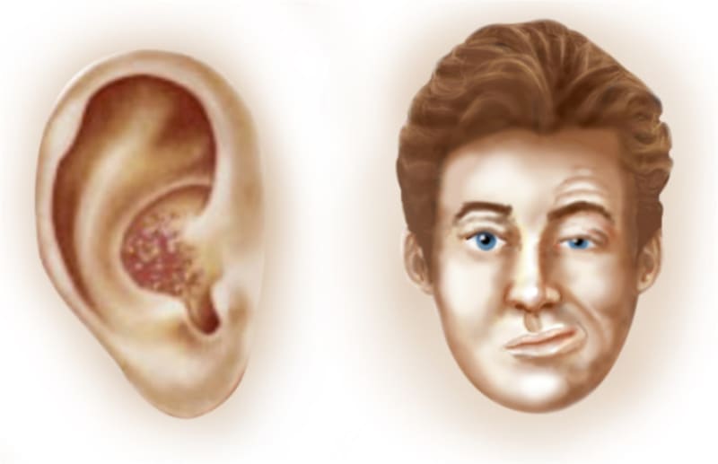 Ramsey Hunt Syndrome
